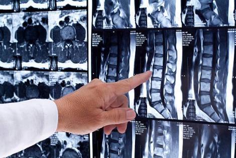 spinal cord injury lawyers Vermilion 2